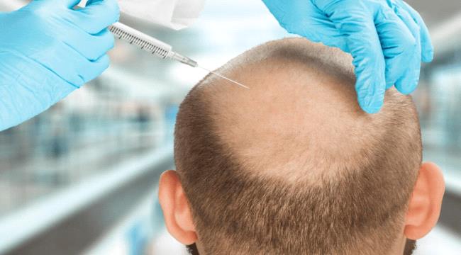 كيف يمكن لدهون الجسم مكافحة الصلع وزيادة كثافة الشعر؟ ...
