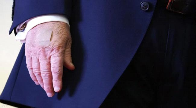 من الكدمات إلى فحص الرنين المغناطيسي..علامات استفهام حول الحالة الصحية لترامب ...