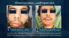 إنجاز طبي غير مسبوق.. إجراء أول عملية متكاملة لعلاج التصاق المفصل الفكي الصدغي في اليمن...