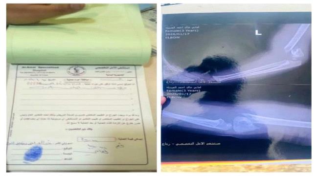 وفاة فتاة بعد عملية عظام بسيطة بمستشفى خاص برداع.. وسط اتهامات طبية 