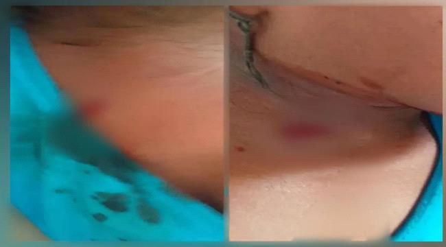 إصابة طفلة برصاص قناصة مليشيا الحوثي في مديرية مقبنة بتعز ...